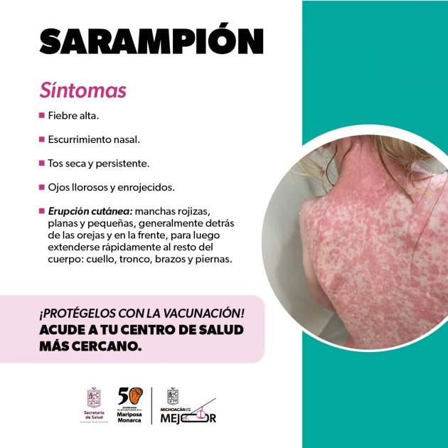 Identifica los síntomas del sarampión y protege tu salud: SSM